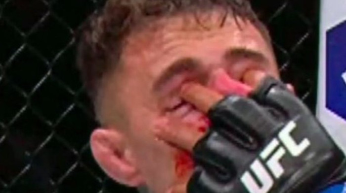 Isplivali novi snimci povređenog UFC borca - Protivnik mu nabio prste u oči (VIDEO)